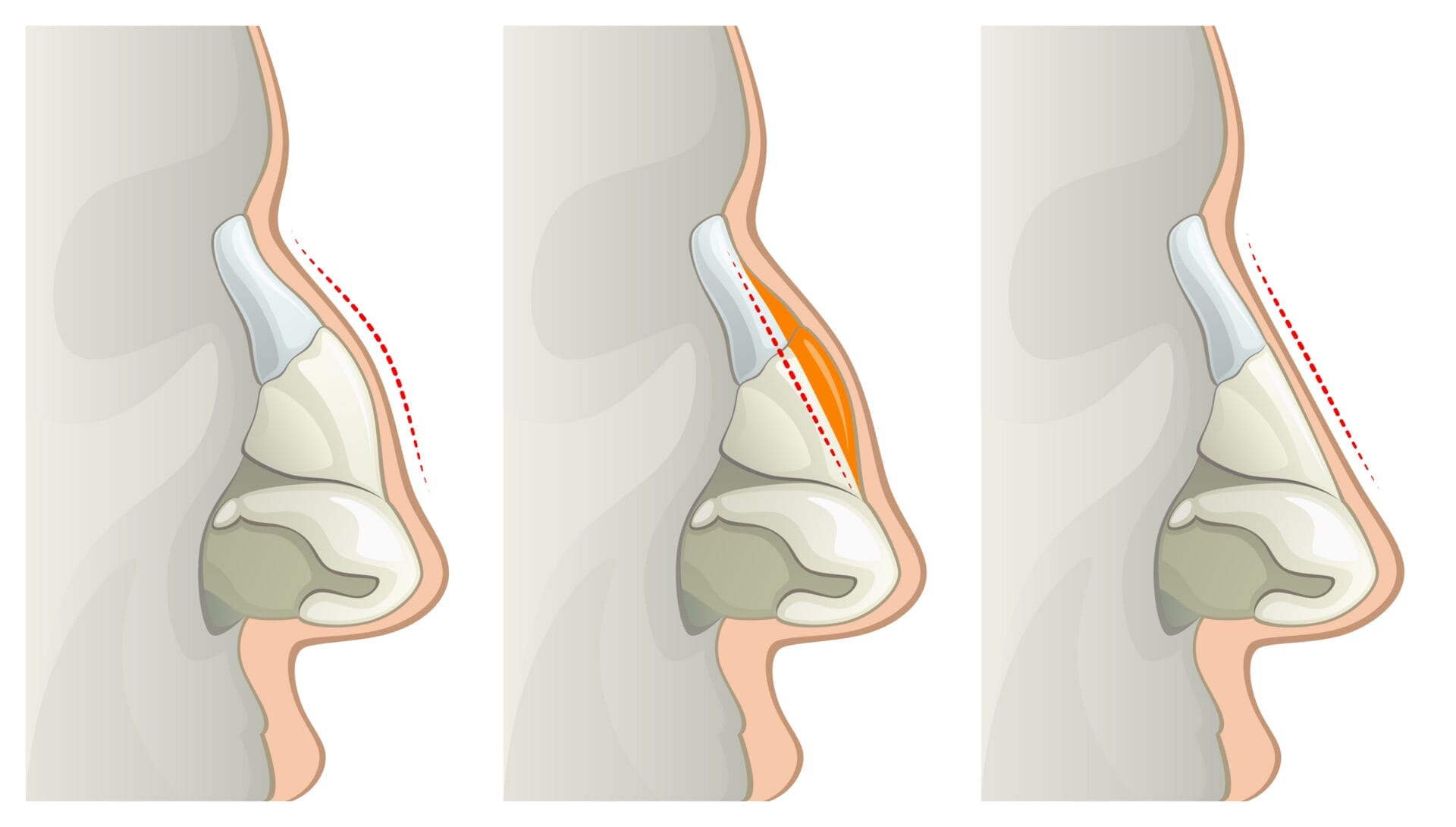 Nose surgery Nose surgery