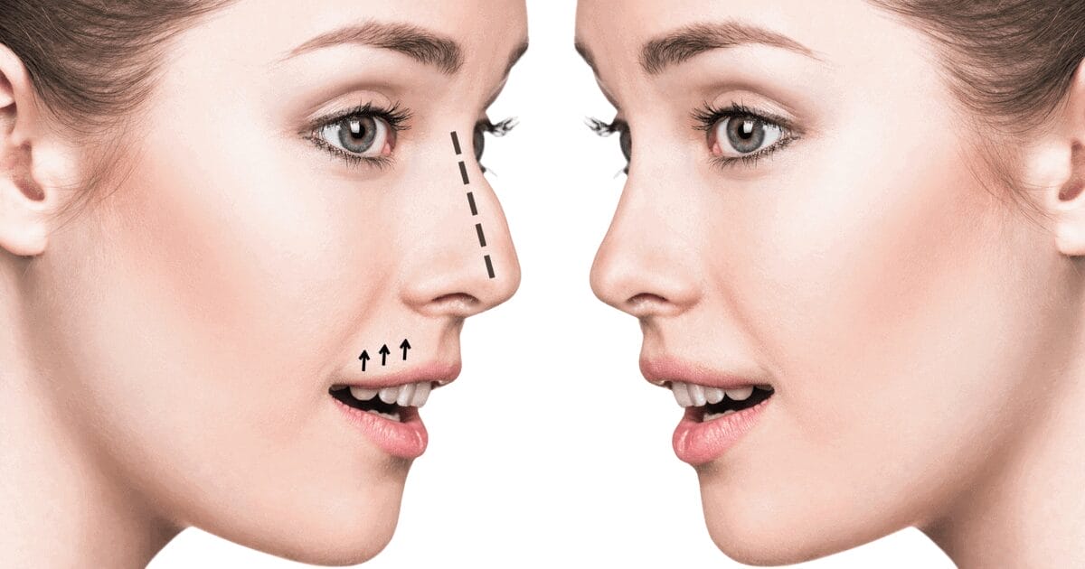 Rhinoplasty Recovery