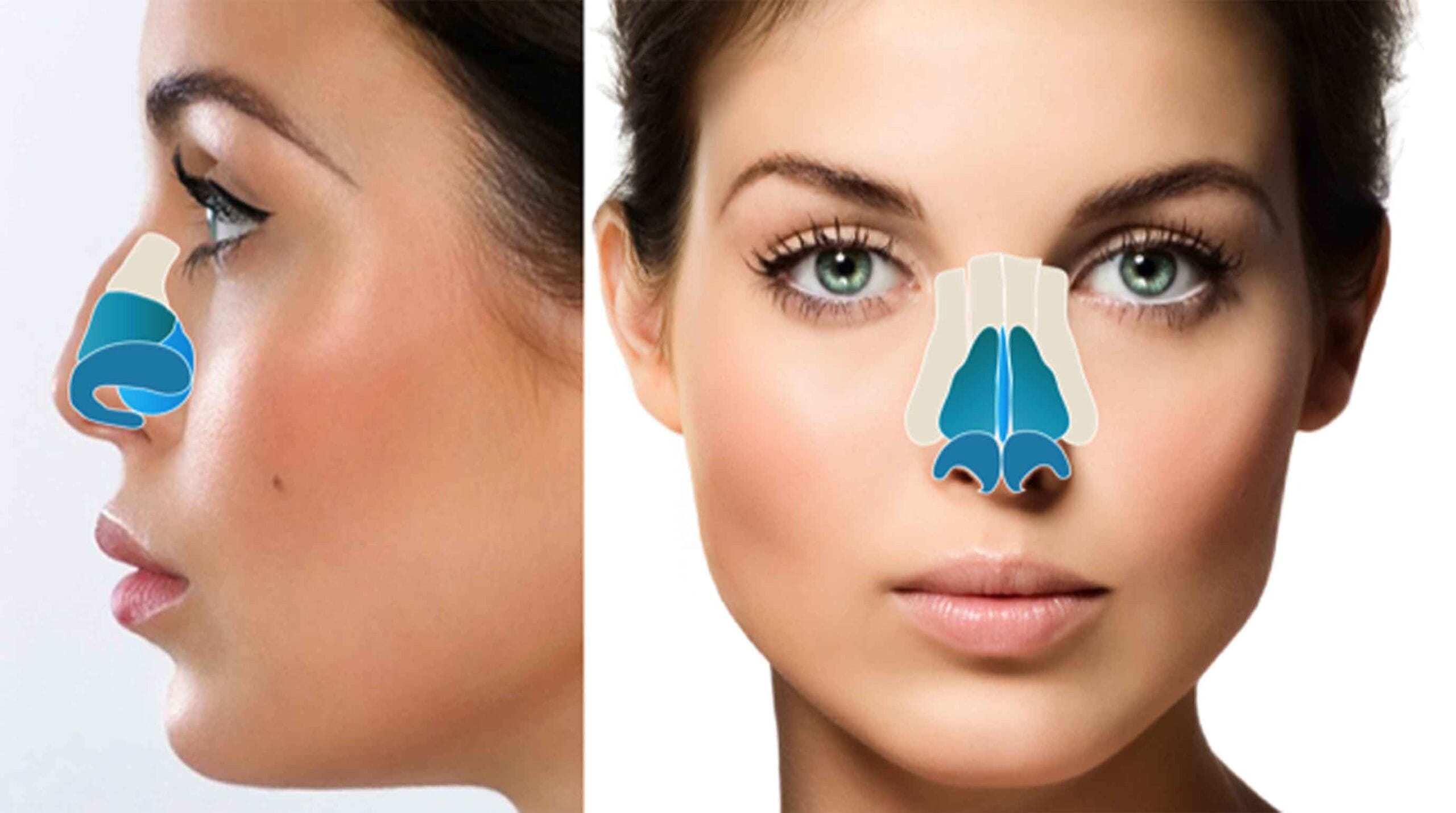 Nose structure Rhinoplasty Surgery