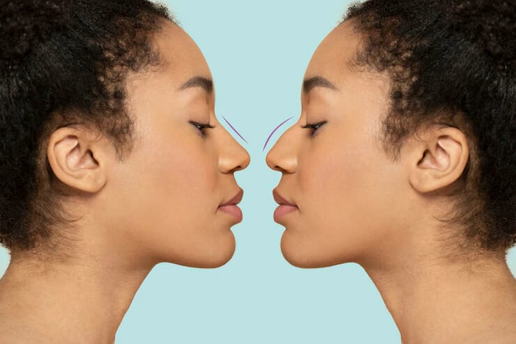 Types of Nose Surgery