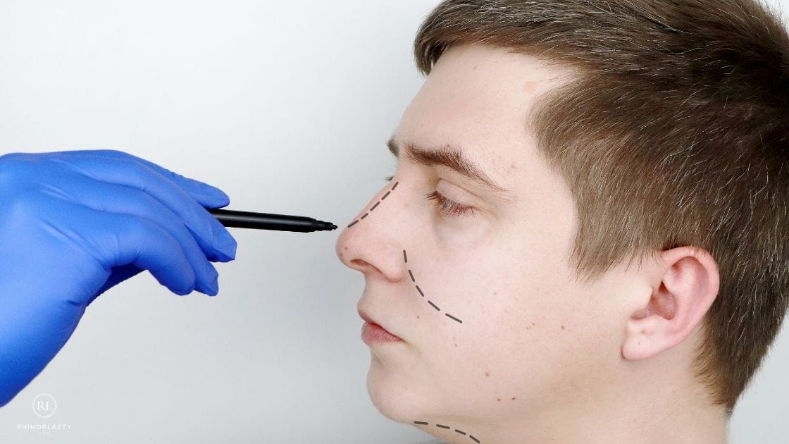 Nose Job for Men