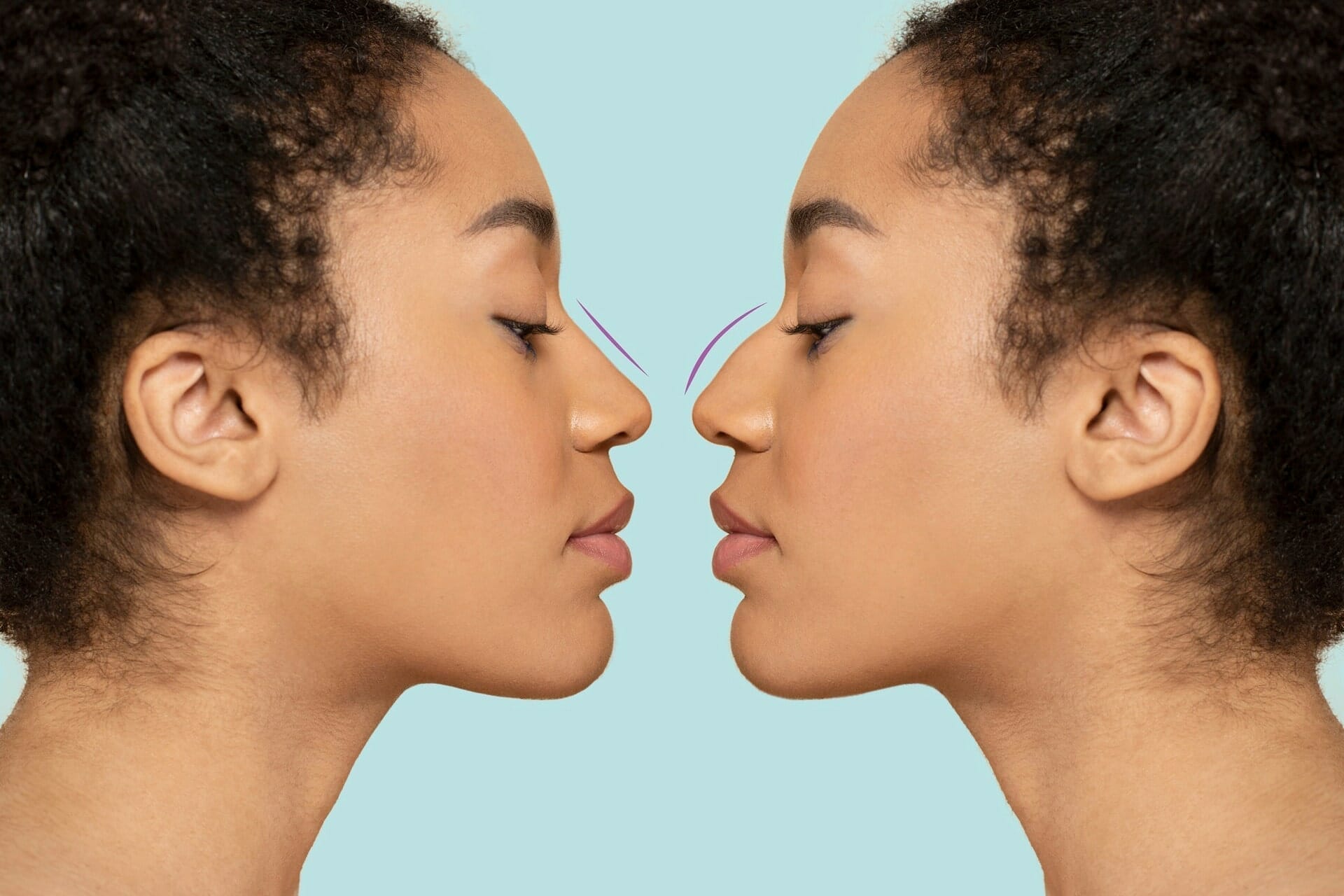 correction rhinoplasty