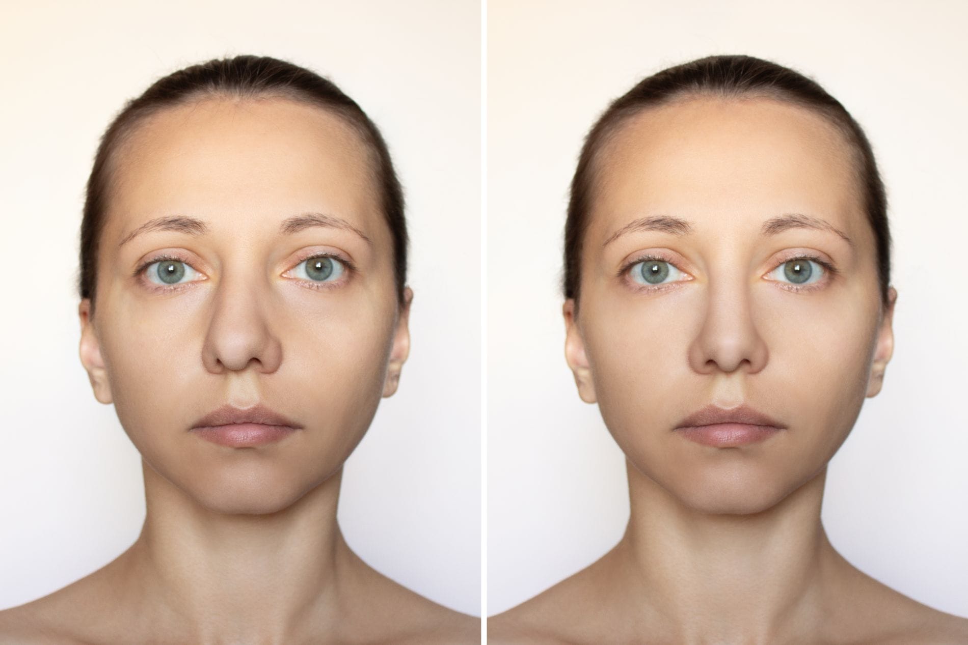 fixed crooked nose