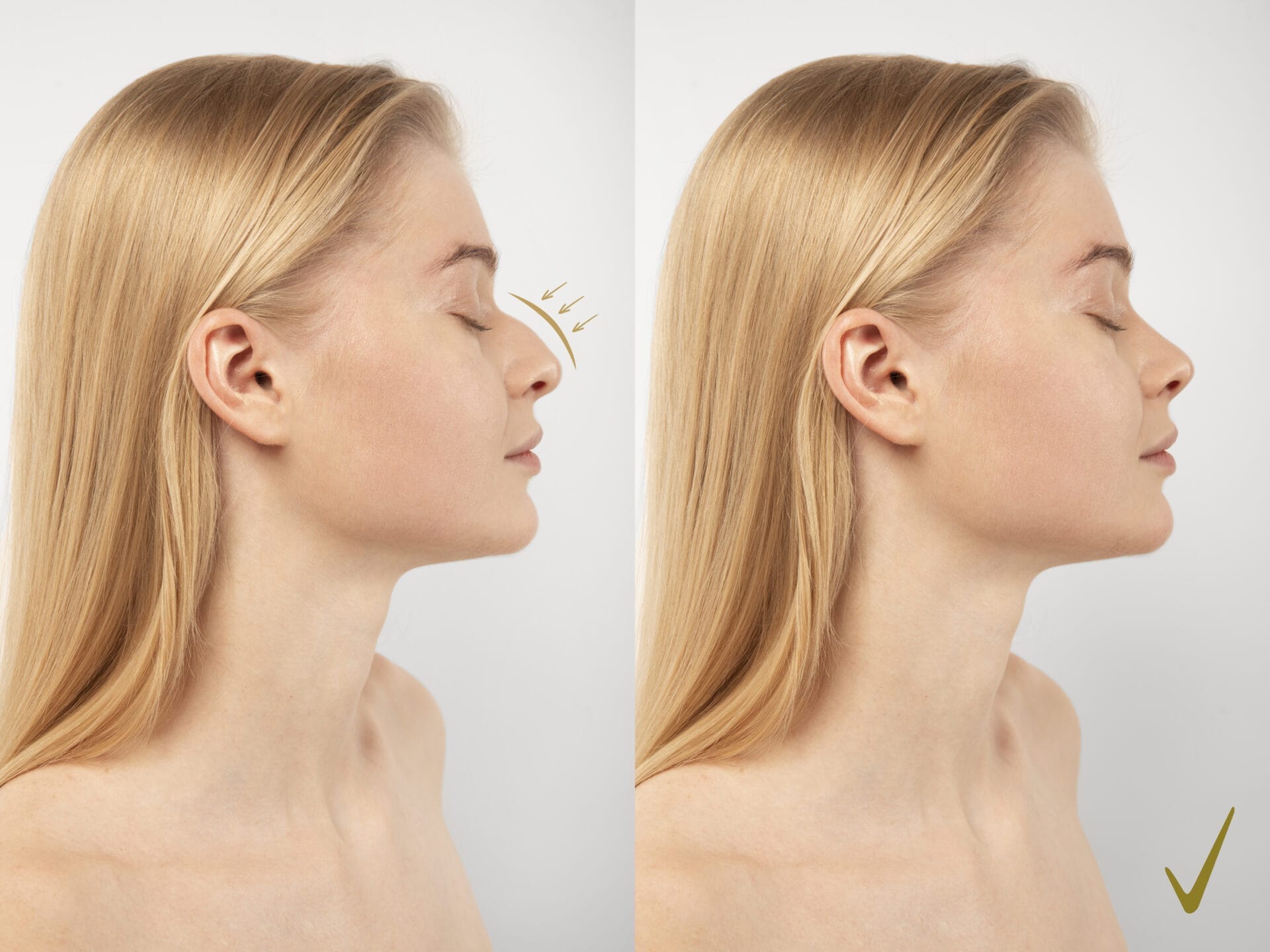 Nose Shape and Size for Rhinoplasty